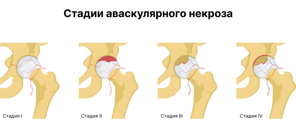 Стадии заболевания тазобедренного сустава